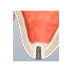Sinus Kit - Image 4