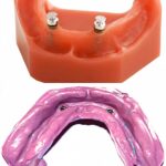 Titanium Transfer For Low-Profile Lock Attachment Internal Hex (SP) - Image 2