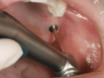 NSK Faster and Safer Implant Treatments iSD900 - Image 6